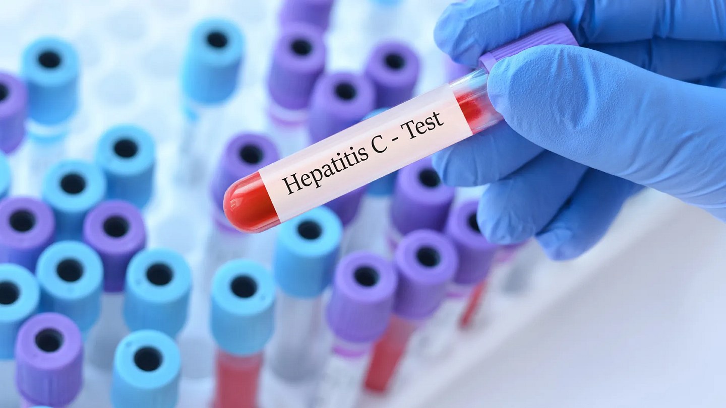 Mortality from viral hepatitis affects 1 in every 5 patients aged 80 in the SUS
