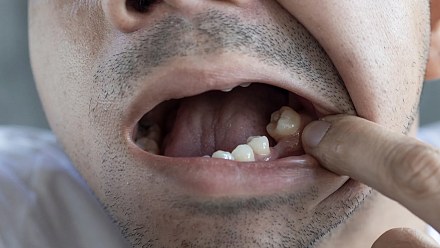 Things that make your tooth fall out