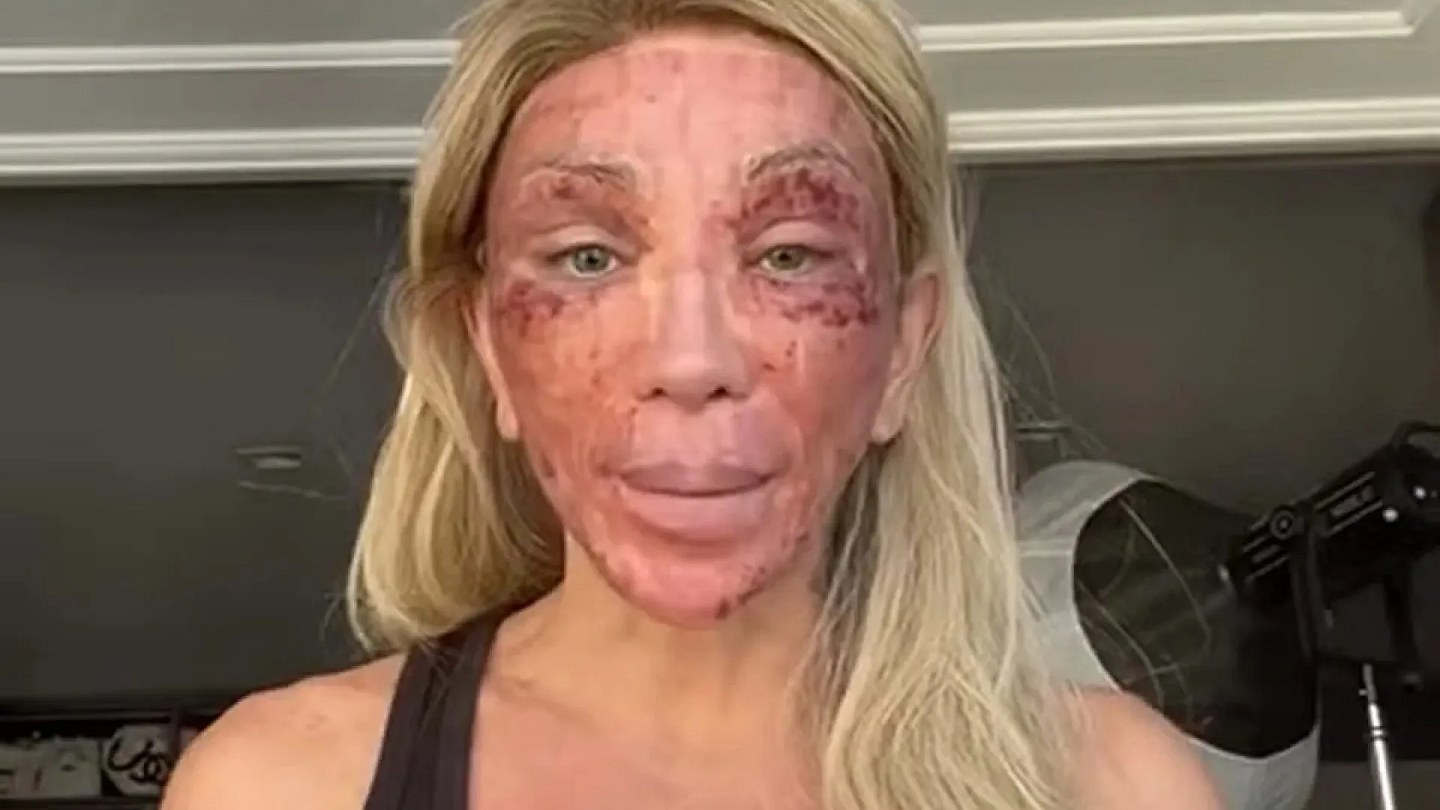 'I can't even laugh', says Maya Massafera shows swollen face after peeling and ironizes reaction: 'I can't even laugh'