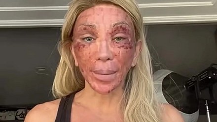 'Não consigo nem rir', diz Maya Massafera mostra rosto inchado após peeling e ironiza reação: 'Não consigo nem rir'