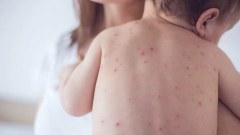 São Paulo registra 14º caso de sarampo, e paciente é um bebê
