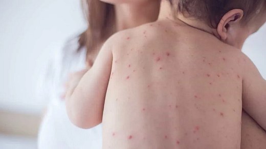 São Paulo records 14th case of measles, and the patient is a baby