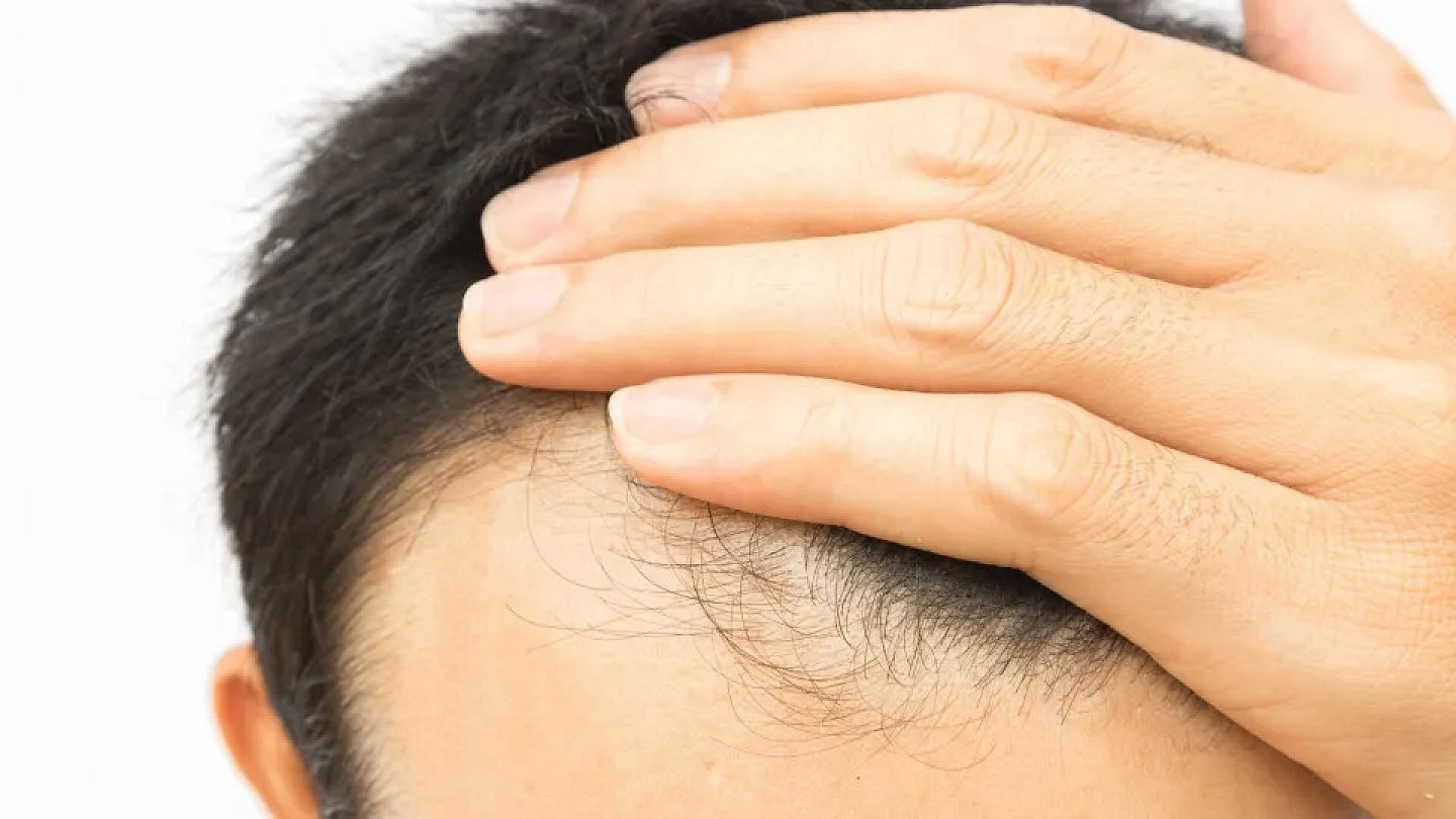 Can transplanted hair fall out? See some details about the procedure