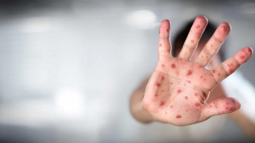 Answer your questions about measles and vaccination to contain the spread of the disease
