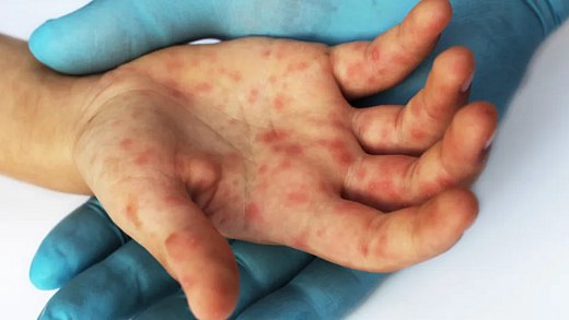 State of SP confirms the 15th case of measles in 2026
