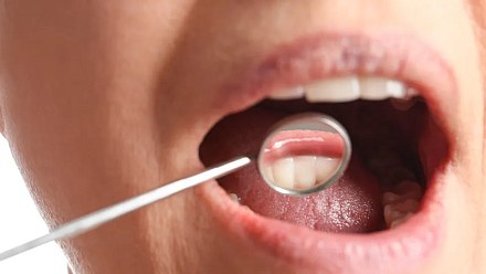 The "hidden pattern" in the mouth that may indicate colorectal cancer risk